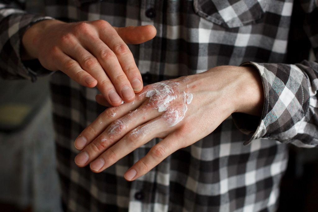 rubbing ointment on burn